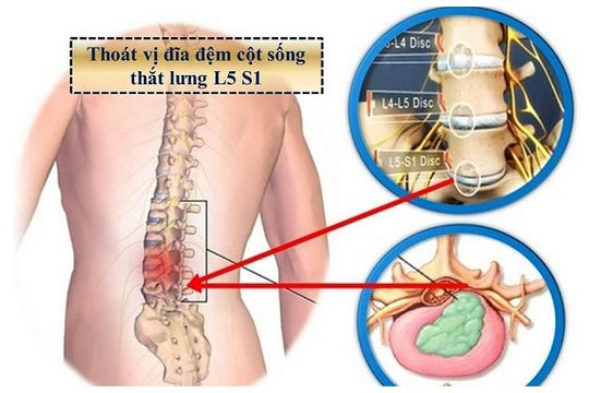 Thoát vị đĩa đệm: Triệu chứng và cách điều trị