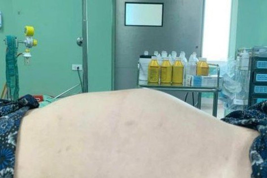 Thiếu nữ 18 tuổi bụng to như mang thai 7 tháng, không ngờ u buồng trứng ‘khủng’