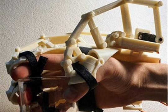 'Găng tay' 3D trợ giúp người bị tai biến, tai nạn gãy xương