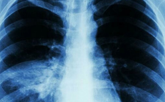 Viêm phổi cộng đồng có thể xảy ra ở mọi người, kể cả người khoẻ mạnh