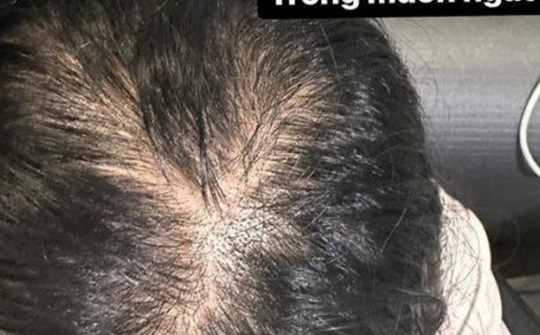 Nguyên nhân và giải pháp để kích thích tóc mọc nhanh, chắc khoẻ rất cần thiết với những người bị hói đầu