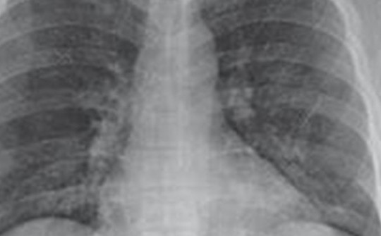 Người phụ nữ có phổi trắng xóa sau 3 ngày nhiễm cúm A