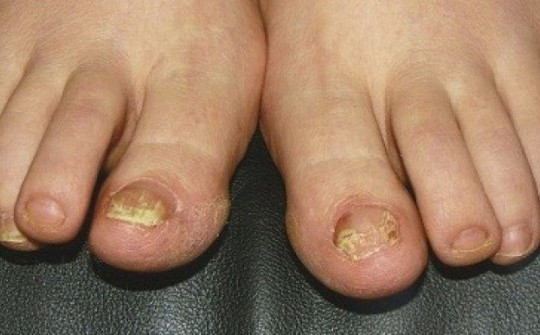 5 dấu hiệu bệnh gan nguy hiểm thể hiện ở bàn chân rất ít người để ý