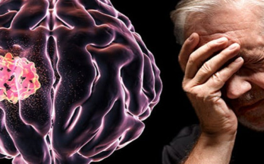 6 dấu hiệu cảnh báo khối u não rất ít người biết đến