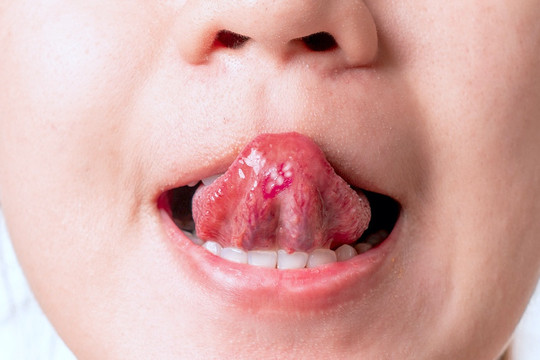 5 điều lưỡi có thể tiết lộ về sức khỏe - từ ung thư đến nguy cơ đột quỵ cũng có thể hiện ra