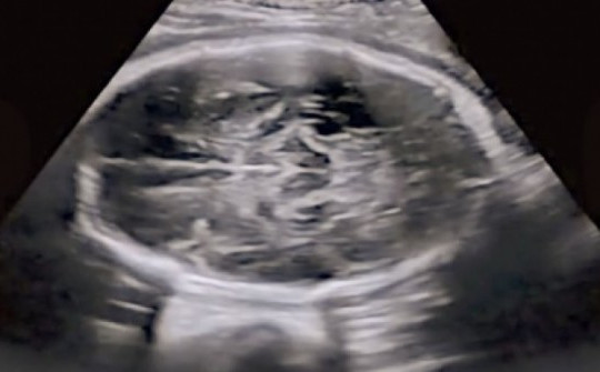 Người phụ nữ sắp sinh mới biết đang mang bầu