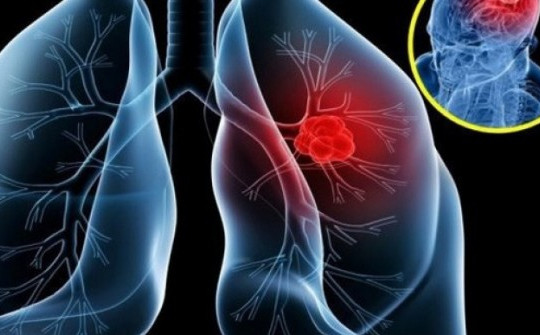 Bác sĩ viện K tư vấn cách phòng tránh ung thư phổi
