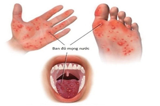 Xu hướng gia tăng số ca mắc bệnh tay chân miệng tại Hà Nội
