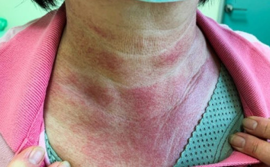 Thấy vết phát ban nổi trên mặt và ngực, không ngờ tế bào ung thư đã lan rộng