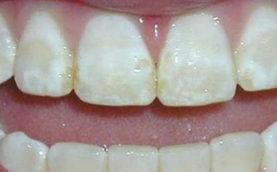 6 bệnh về răng miệng nguy hiểm cần phát hiện sớm