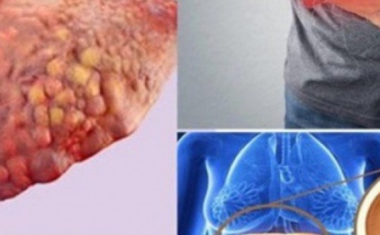 6 nhóm người có nguy cơ cao mắc bệnh gan nhiễm mỡ