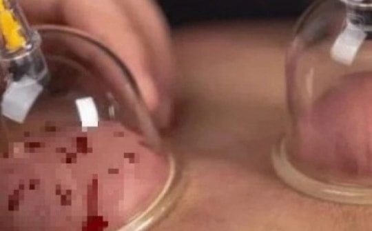 Người đàn ông 35 tuổi đột quỵ sau giác hơi, những ai không nên thực hiện phương pháp này?