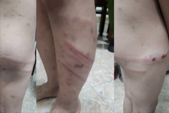 Khẩn trương điều tra vụ việc bé trai 11 tuổi nghi bị bạo hành ở Phú Thọ
