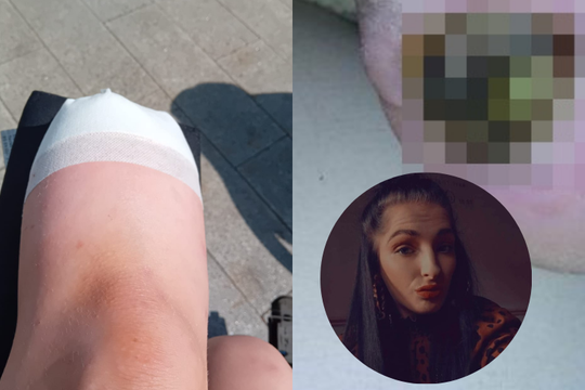 Cô gái 24 tuổi phải cắt cụt một chân vì vết phồng rộp nhỏ do đi giày thể thao, cảnh báo "điều có thể xảy ra với bất cứ ai"