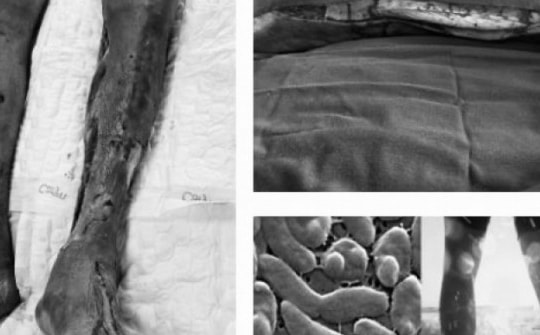 Người đàn ông nguy kịch do “vi khuẩn ăn thịt người”