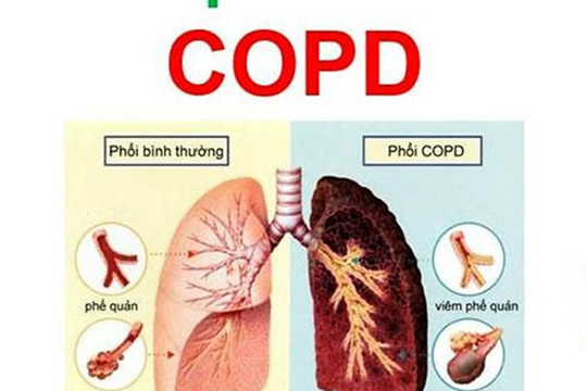 Sống khỏe với bệnh phổi tắc nghẽn mạn tính (COPD)