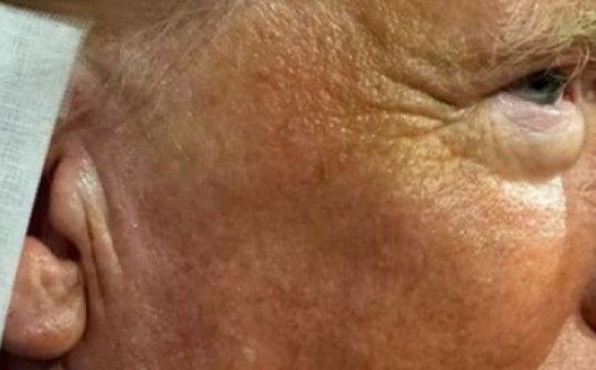 Băng tai của ông Trump thành xu hướng
