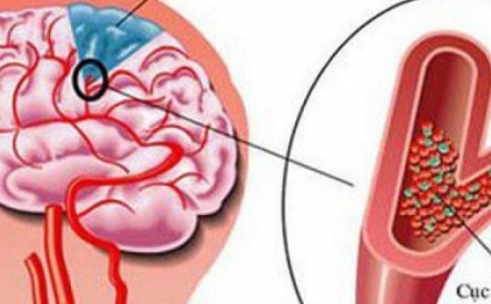 Những thói quen xấu khiến bạn dễ bị đột quỵ