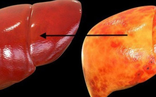 Những thói quen khiến bạn nhanh mắc gan nhiễm mỡ