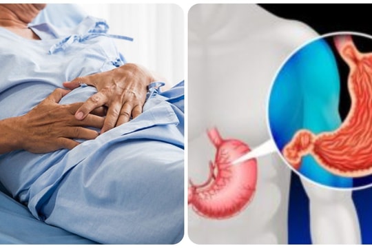 Dấu hiệu ung thư dạ dày giai đoạn cuối