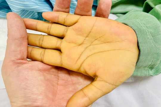 5 dấu hiệu nhận biết sớm ung thư gan không nên bỏ qua