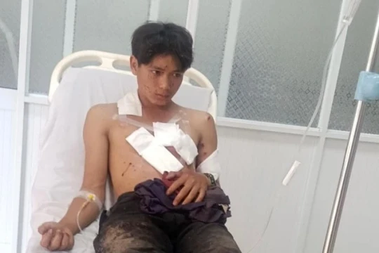 Mìn nổ trên tay, 2 người bị đa chấn thương