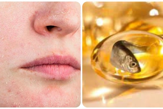 5 dấu hiệu cho thấy cơ thể bạn đang thiếu Omega-3