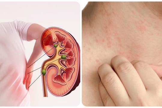 5 dấu hiệu suy thận giai đoạn đầu bạn cần biết