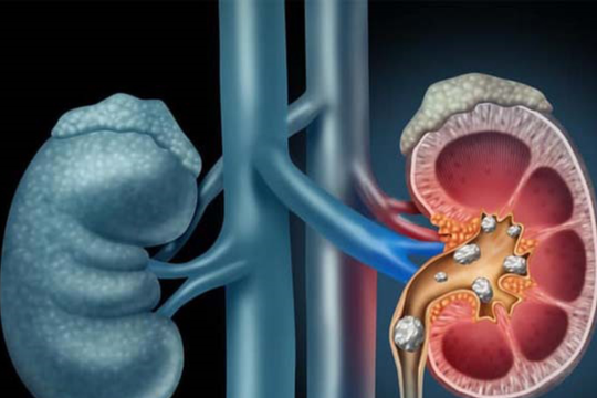 5 triệu chứng cảnh báo tổn thương thận không nên bỏ qua