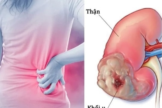 Dấu hiệu thầm lặng cảnh báo ung thư thận