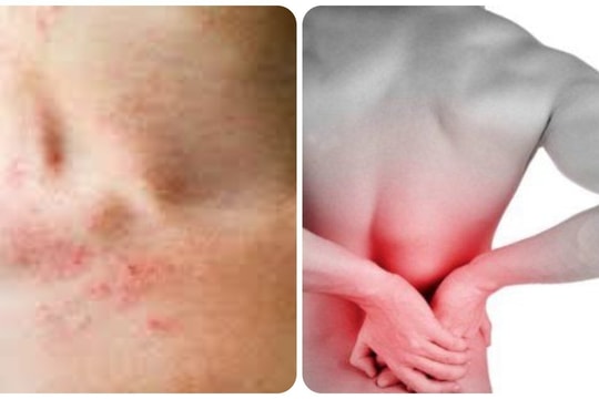 Những triệu chứng suy thận nhẹ bạn cần biết