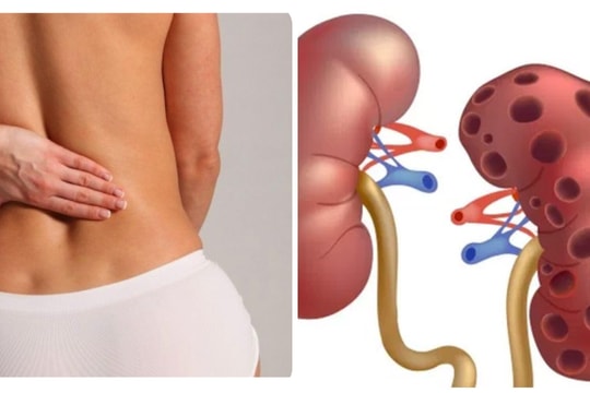 9 dấu hiệu thận yếu ở phụ nữ