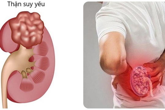 Dấu hiệu nhận biết thận khỏe hay yếu