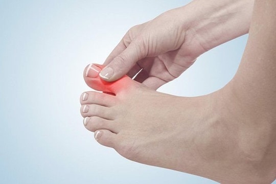Giải pháp hỗ trợ cải thiện cho người bệnh gút hiệu quả từ thảo dược