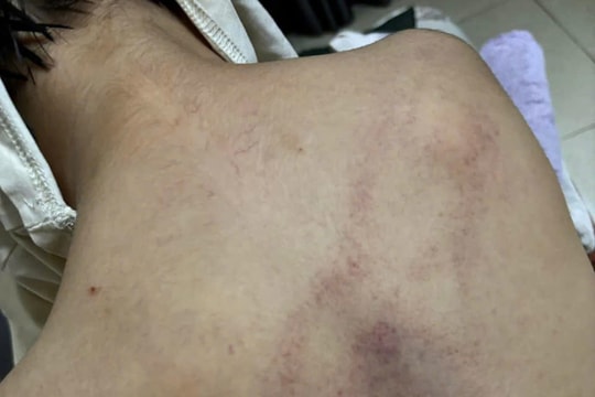 Bé 4 tuổi bị đánh tím lưng ở lớp