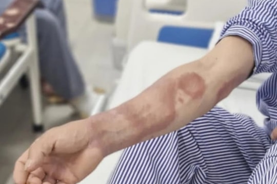 Từ chấm nhỏ đổi màu ở vùng thắt lưng, thanh niên trẻ phát hiện bệnh phong
