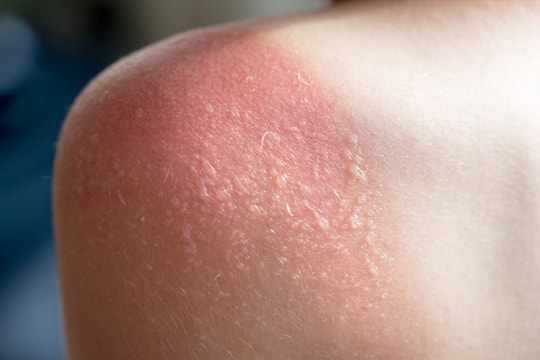 Bỏng nắng và các phản ứng khác của da với ánh nắng mặt trời