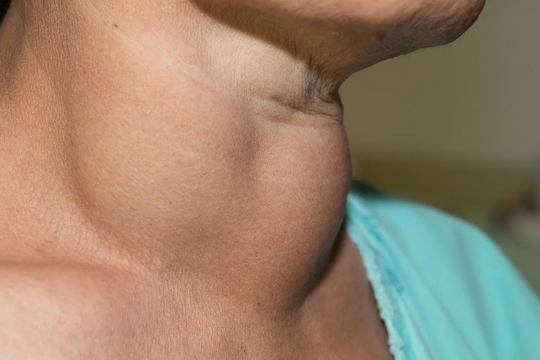 Bướu cổ lành tính: Nguyên nhân, triệu chứng và cách xử lý an toàn
