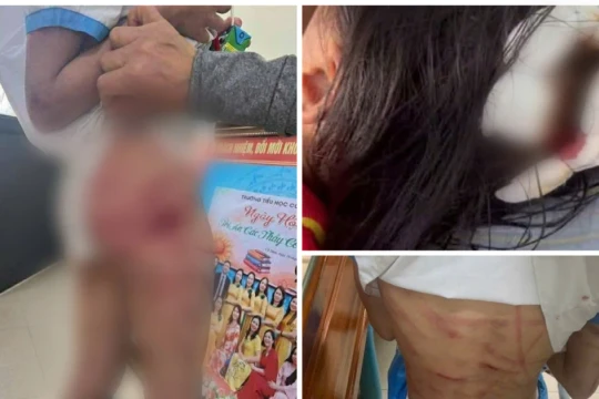 Công an điều tra vụ bé gái lớp 5 bị cha dượng bạo hành ở Hà Tĩnh