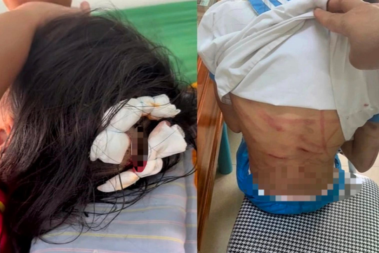 Nữ hiệu trưởng rụng rời khi bé gái lớp 5 thương tích khắp người, nghi bị bố dượng đánh