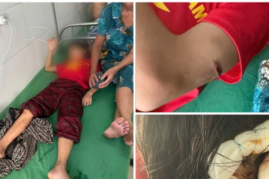 Trường học lên tiếng vụ học sinh lớp 5 nghi bị cha dượng bạo hành