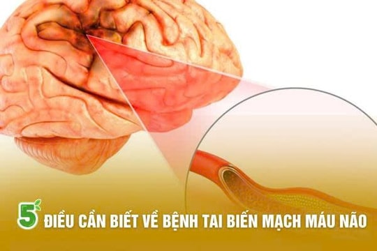 5 điều cần biết về bệnh tai biến mạch máu não