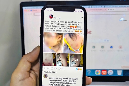 Bé gái 3 tuổi bị nhiều vết bầm tím, dấu răng trên người sau giờ học