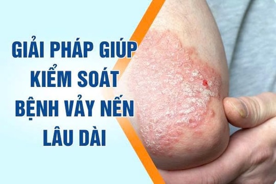 Cách kiểm soát vảy nến lâu dài, giảm ngứa và ngăn tái phát
