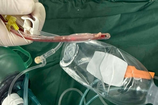 Bé 3 tuổi tử vong sau khi sặc thức ăn tại nhà trẻ