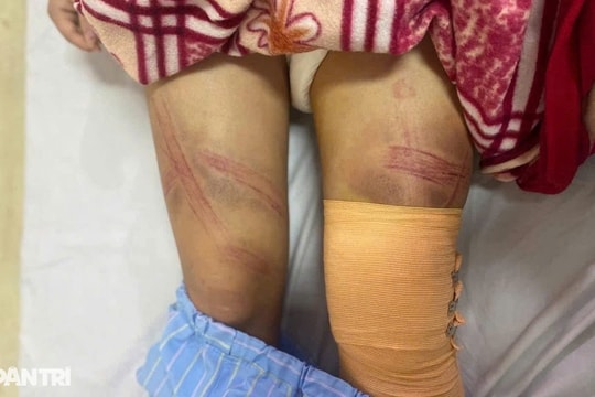 Nữ sinh lớp 7 nhập viện với nhiều vết bầm trên cơ thể