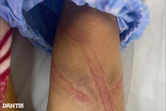 Vụ nữ sinh lớp 7 nghi bị bạo hành: Vì con lợn đất không còn tiền?