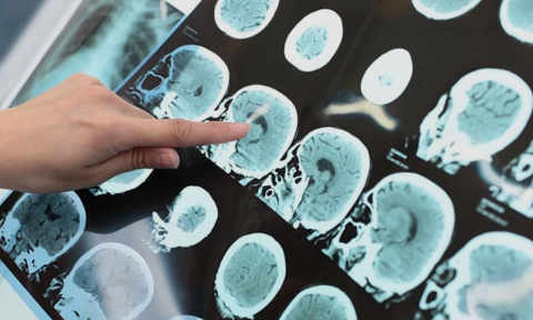 Những 'cú sốc nhiệt' kích hoạt đột quỵ khi trời lạnh