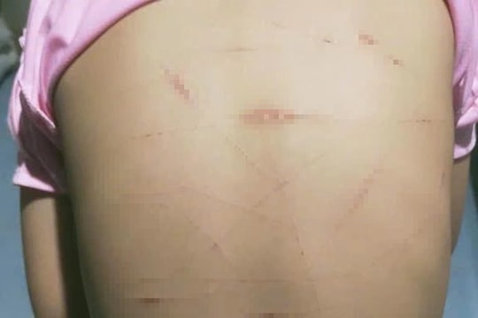 Vụ học sinh lớp 5 ở Cà Mau nghi bị bạo hành: Công an báo cáo vụ việc ban đầu như thế nào?