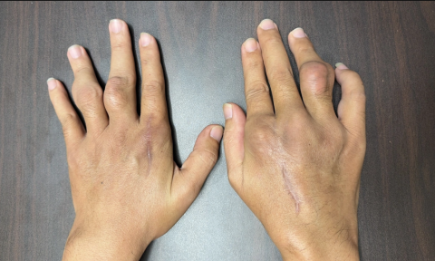 Bí quyết kiểm soát bệnh gout dịp Tết